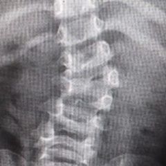 Ortopedistas del IMSS corrigen malformación de columna a niña de 4 años con retiro de una vértebra