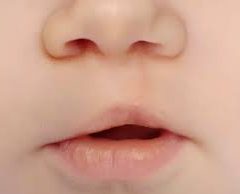 Operan gratuitamente a niños con labio y paladar hendido, en Cuauhtémoc