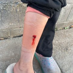 Menor de edad lesionada por mordedura de perro