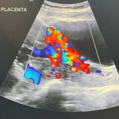Logra Clínica para la Prevención y Manejo de Hemorragia Obstétrica salvar la vida de 15 mujeres en 2025.